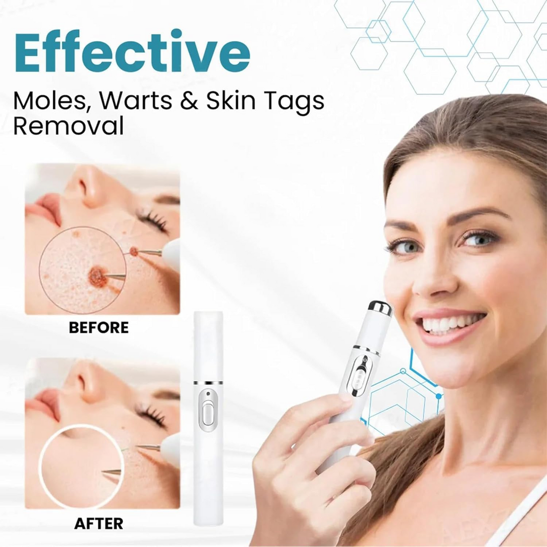 Non-Invasive Mole and Wart Removal Laser Pen